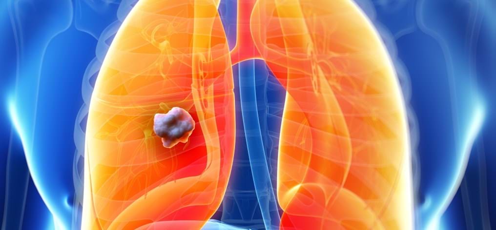 Day 93: Fighting lung cancer with personalised medicine