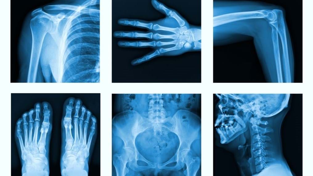 Day 101: A new approach to bone injuries